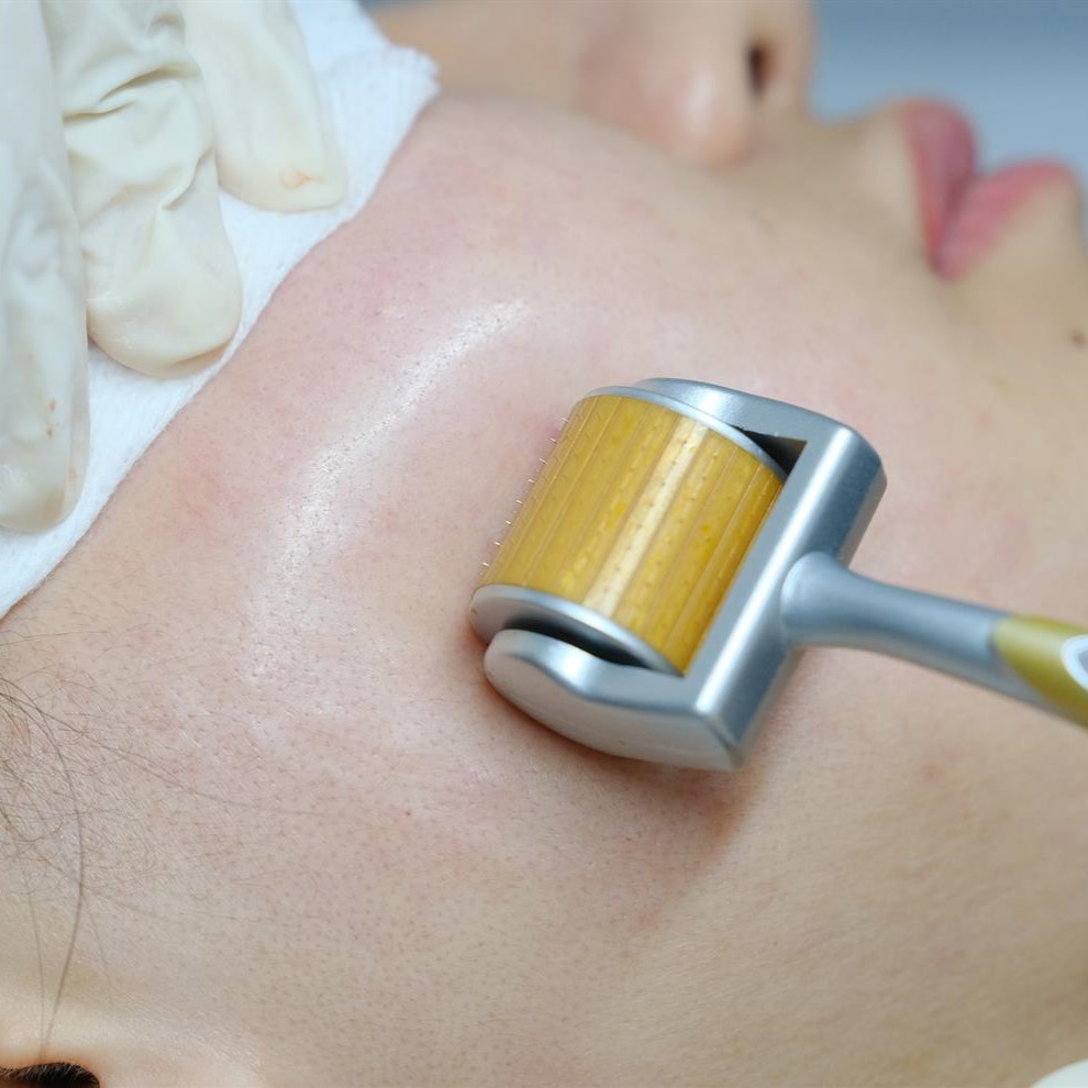Vi kim tạo collagen là gì? Có thật sự cải thiện sẹo rỗ?